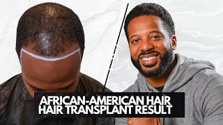 Amazing Transformation 1 Year RESULT: Leeoh Litt's Hair & Beard Transplant Journey  HEVA @leeohlitt