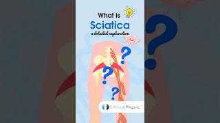 What is Sciatica #physicaltherapy #physiotherapy #sciatica #sciaticnervepain #sciaticapain