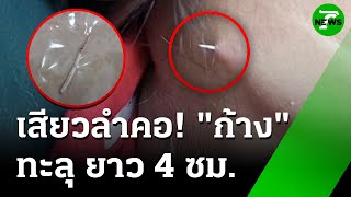 อุทาหรณ์ ก้างปลาติดคอ เสียบทะลุ ยาว 4 ซม. | 18 มิ.ย. 68 | ข่าวเช้าหัวเขียว
