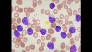 Pathology -- dr. Nafe'a --  Acute lymphoblastic leukemia (ALL) أورام