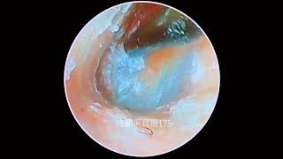 Satisfying Ear Wax Removal With Dr Zhao Video #98