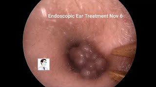 Electric knife dissection of external auditory canal tumor