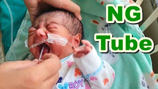 Nasogastric (NG) Tube Insertion in Neonate / Newborn | Orogastric Tube / Feeding Tube