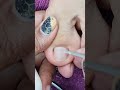 laki ng ingrown 😱 ingrown_toenail satisfyingvideos