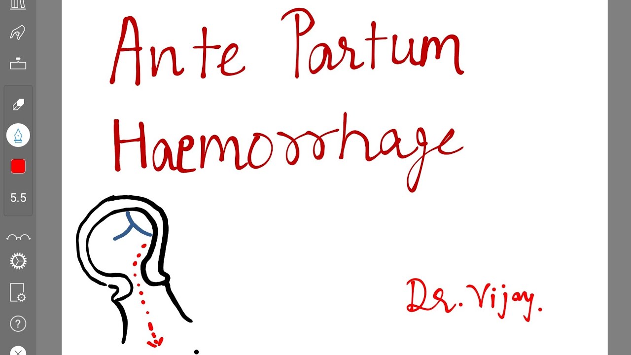 Antepartum Haemorrhage Youtube Antepartum Haemorrhage Youtube