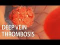 Venous thromboembolism | Deep vein thrombosis (DVT)  | medical animation