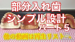 部分入れ歯その5　埼玉県さいたま市歯医者大宮鈴木歯科医院デンタル歯科クリニック　西口駅近く　保険適応　違い　金属床　スマイルデンチャー比較　三橋　大成　宮原　桜木町　櫛引　上小町　良心的優しい