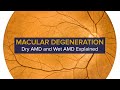 Macular Degeneration Explained - Diagnosis, Symptoms and Treatment of Dry and Wet AMD