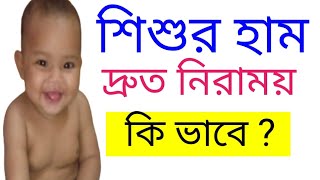 শিশুদের হাম নিরাময় করবেন কিভাবে  how to cure child fever with skin eruption and rash