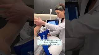CoolSculpting Elite at The Skin Center