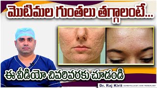 మొటిమల గుంతలు || Best Treatment for Acne Scars In Telugu || Pimple Scars || Celestee Clinic