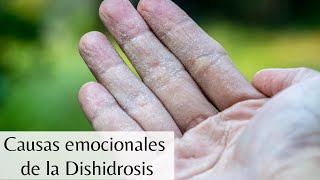 ¿Qué causa la dishidrosis?