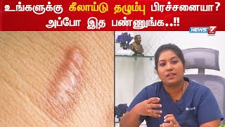 உள்ளங்கையில் மருத்துவத்தில் இன்று - கீலாய்டு தழும்பு | Keloid scar | Dr.Kavitha