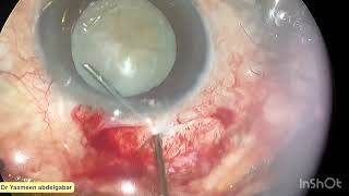 Sics in mature hard cataract