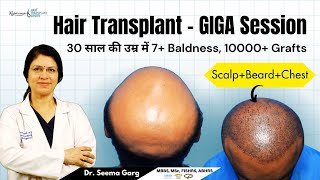 30 साल की उम्र में VII Baldness, 10000 Grafts | Hair Transplant in Indore | Best Hair Transplant