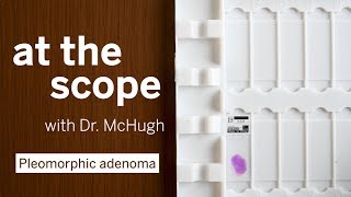 At The Scope with Dr. McHugh: Pleomorphic adenoma