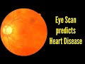 AI can identify heart disease from an eye scan | Using the eye as a window into heart disease