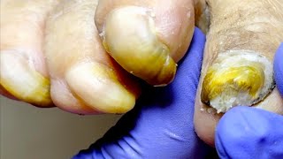 Onychomycosis Is Like A Round Stone, So Trim It Carefully!【Pedicure King】