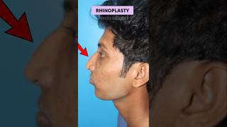 Cost of Rhinoplasty Surgery in Mumbai ? | Before -  After Result