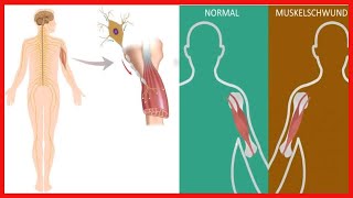 Neuromuskuläre Erkrankungen: Wissenswertes