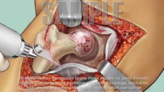 Total Hip Replacement Surgery: Medical Animation