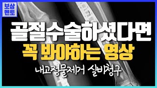 [실손의료비] 골절수술 하셨나요? 실비 가입시기에 따라서, 모르면 손해볼 수 있습니다! -상해입원의료비 [60화]