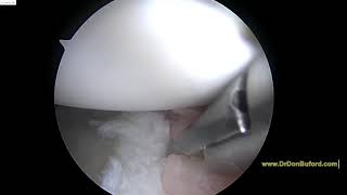 Left Shoulder Bankart Lesion (shoulder dislocation)