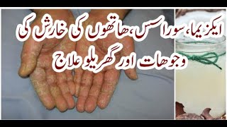 hatho ki allergy (eczema) ka ilaj