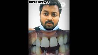 எளிய முறையில் முன் பற்கள் கட்டுவது எப்படி? Fixed replacement of front teeth within one week