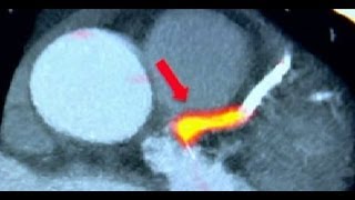 HOW TO PREDICT A HEART ATTACK - BBC NEWS