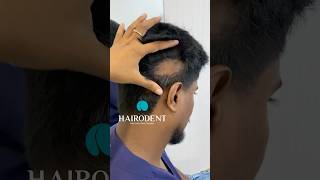 Alopecia ബാധിച്ച സ്ഥലത്തു Transplant ചെയ്തപ്പോൾ 😍#drsreenath #hairodent #alopecia