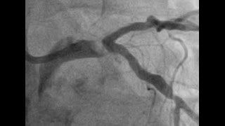 CABG or PCI for this left main NSTEMI?