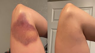 Get Rid of Bruises Fast!