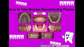 How to Take Bracket Repositioning / Rebracketing/ Repo Photos