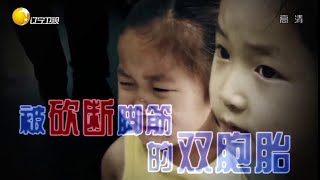 5歲雙胞胎被繼爺爺砍斷腳筋，只因三年前壹拳懷恨在心#故事大王