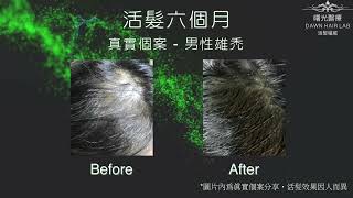 曙光醫療 Dawn Hair Lab【成功個案分享 - 57歲男性頭頂稀薄】