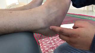 सियाटिका मर्म /Marma -kanpugaichal Marma,Sciatica pain ,Referred pain in the leg