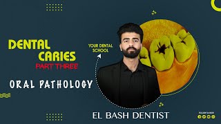 dental caries | part 3 | oral pathology _ عزت شومان