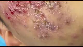 Deep blackheads removal new, big pimple pop up, blackheads extraction 2022 newest #blackheads #acne