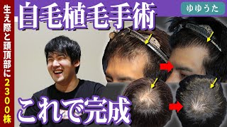 【自毛植毛】有名YouTuberゆゆうたさん、植毛手術から1年後完成のインタビュー！！【植毛】【薄毛】