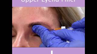 upper eyelid filler by Dr. Tsay Ageless MD