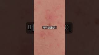 인류 역사상 가장 큰 고통을 준 병