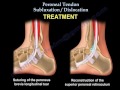 peroneal tendon subluxation dislocation everything you need to know dr. nabil ebraheim