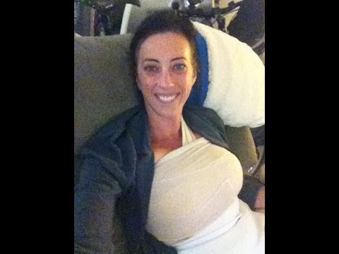 Day 2 Post Op Tummy Tuck W Mrt Lift Augmentation Day 2 Post Op Tummy Tuck W Mrt Lift Augmentation