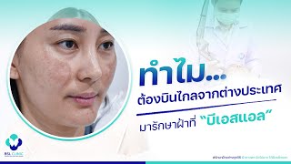 รักษาฝ้า | EP.17 | ฝ้า กระ รอยดำ รักษาที่นี่ แล้วได้สิ่งที่ดีที่สุดกลับไป | BSL Clinic