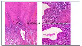 POPMA Study Club 2 (2024):  Histologic Translation of Molecular Signals in OSCC