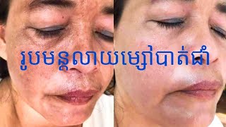 របៀបលាយម្សៅ បាត់ជាំ បាត់មុន នឹង មុខប្រហោង | ส้อนผสมครีมรักษาฟ้า กระ แบบเขมร