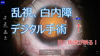 乱視を治す　デジタル白内障手術　技術とコンピューターの融合  cataract surgery with image guidance system