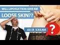 Will Liposuction Give Me Loose Skin?  Ask Dr Schulman