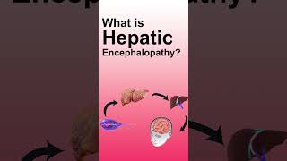 Understanding Hepatic Encephalopathy: Causes, Symptoms, and Treatment by Dr Narendra Maheshwari